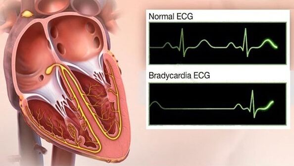 bradykardia pri hypertenzii